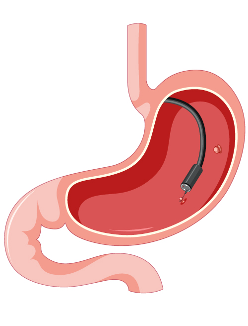 endoscopia_con_inteligencia_artificial_clinica_de_endoscopia_avanzada