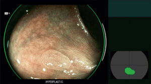 MODO-BLI-HIPERPLASICO_endoscopio_cadeye_fujifilm_clinica_endoscopica_avanzada