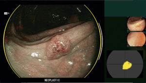 modo_bli_endoscopio_cadeye_fujifilm_clinica_endoscopica_avanzada