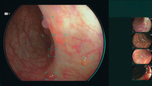 endoscopio_cadeye_fujifilm_LCI_clinica_endoscopica_avanzada