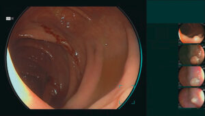 endoscopio_cadeye_fujifilm_modo_luz_blanca_clinica_endoscopica_avanzada