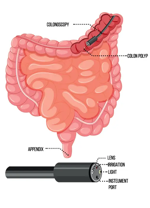 colonoscopia_con_inteligencia_artificial_clinica_endoscopica_avanzada