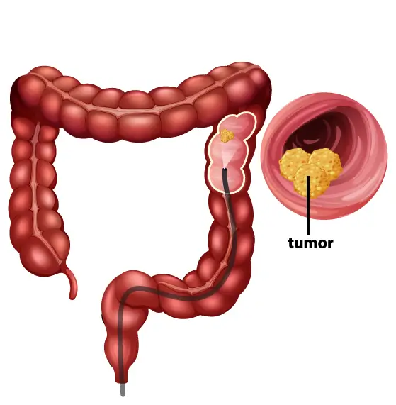 colonoscopia_clinica_de_endoscopia_avanzada