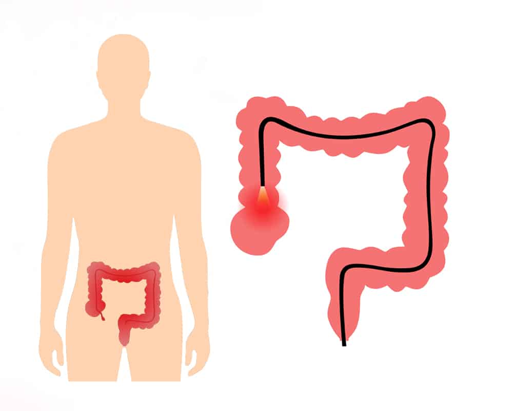 colonoscopia_con_ia_clinica_de_endoscopia_avanzada