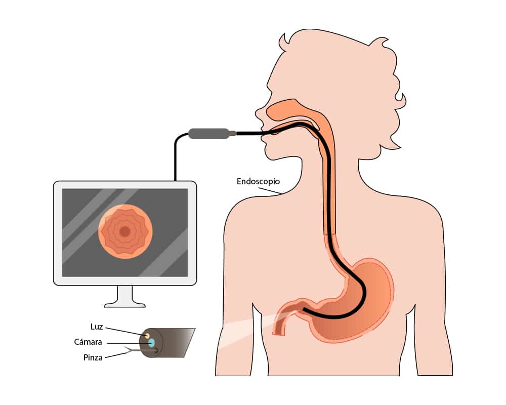 endoscopia_con_inteligencia_artificial_clinica_de_endoscopia_avanzada