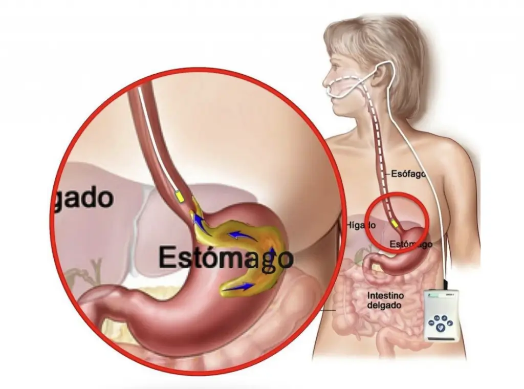 diagnostico_manometria_clinica_endoscopia_avanzada