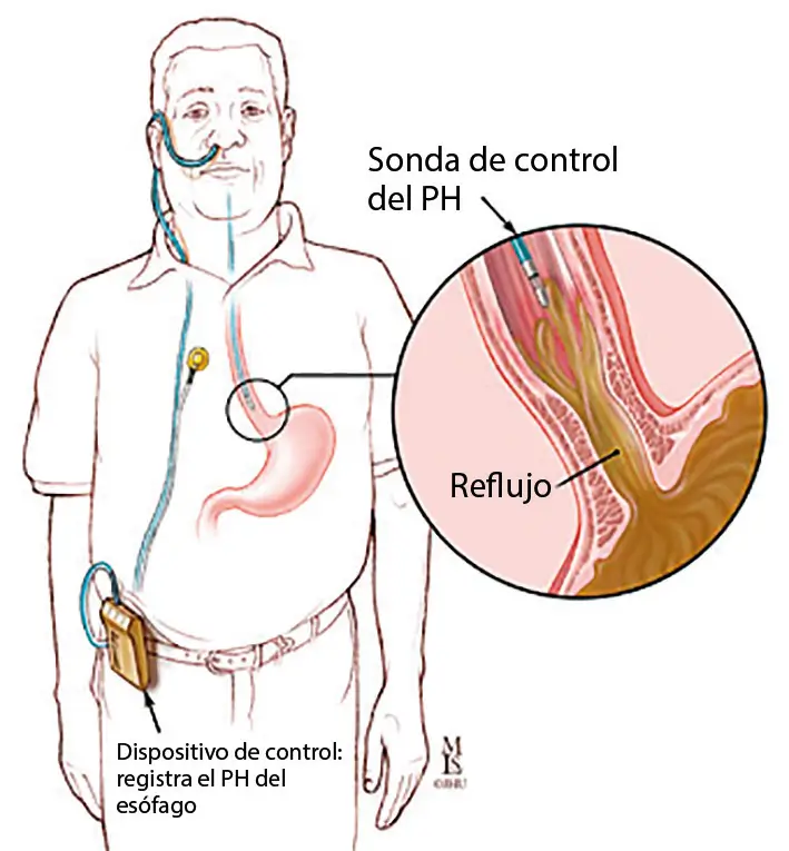 examen_phmetria_clinica_endoscopia_avanzada