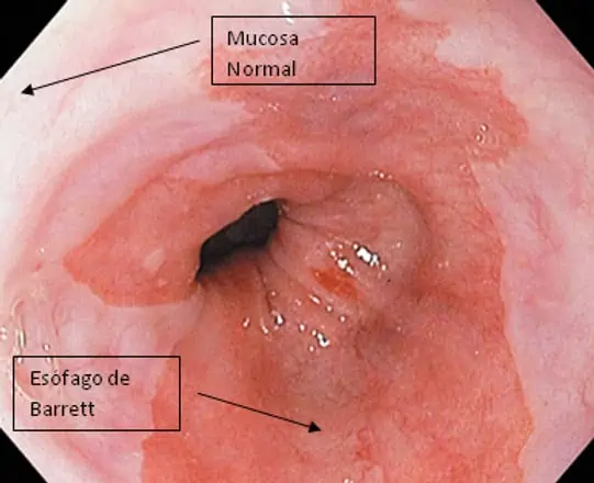 reflujo-gastrico-acidez-gastrica-sintomas-enfermedad-esofago