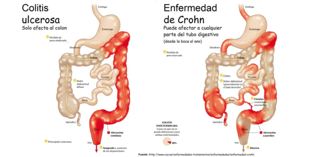 clinica_de_endocopía_avanzada - Enfermedades gastrointestinales Infografía comparativa entre colitis ulcerosa y Crohn
