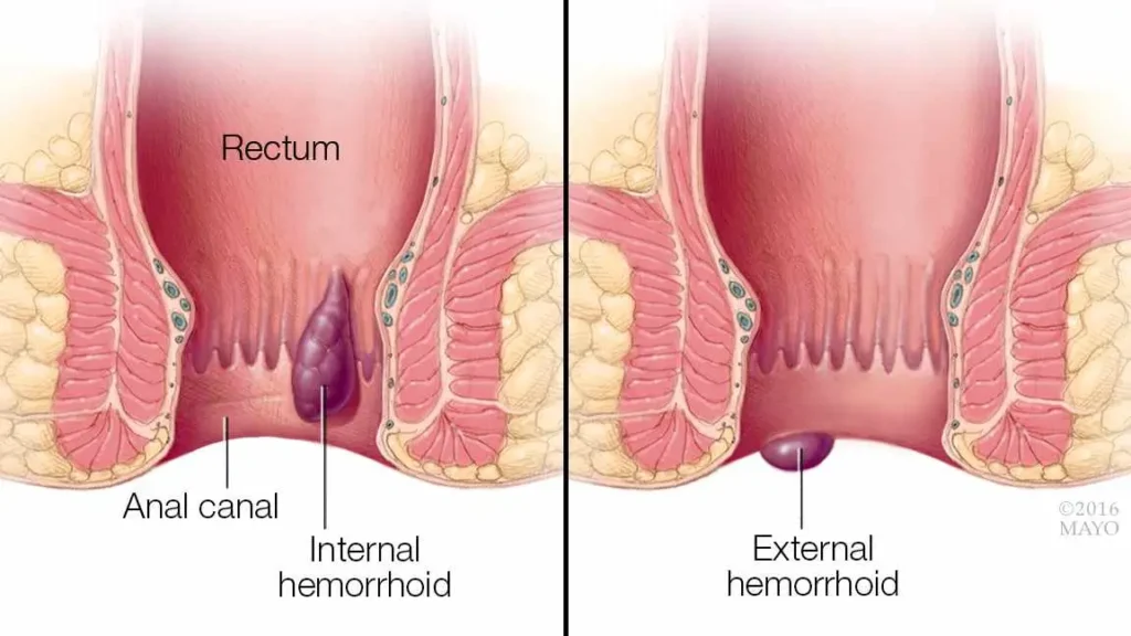 clinica_de_endocopía_avanzada - síntomas de hemorroides Foto médica de hemorroides externas inflamadas