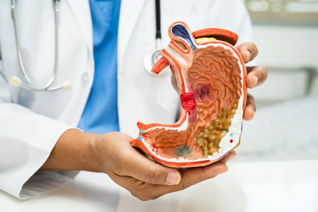 clinica_de_endocopía_avanzada - gastritis síntomas Imagen de un estómago inflamado explicando qué es la gastritis - clinica de endoscopia avanzada