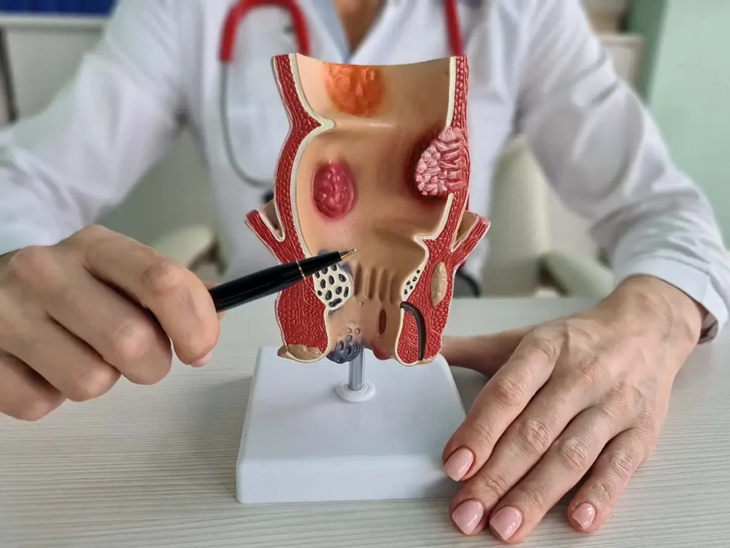 Representación gráfica de causas frecuentes de hemorroides