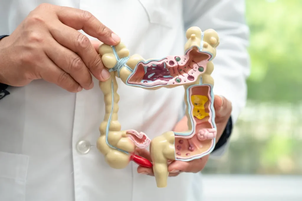 clinica_de_endocopía_avanzada - colon irritable sintomas Imagen explicativa del síndrome de intestino irritable y el sistema digestivo