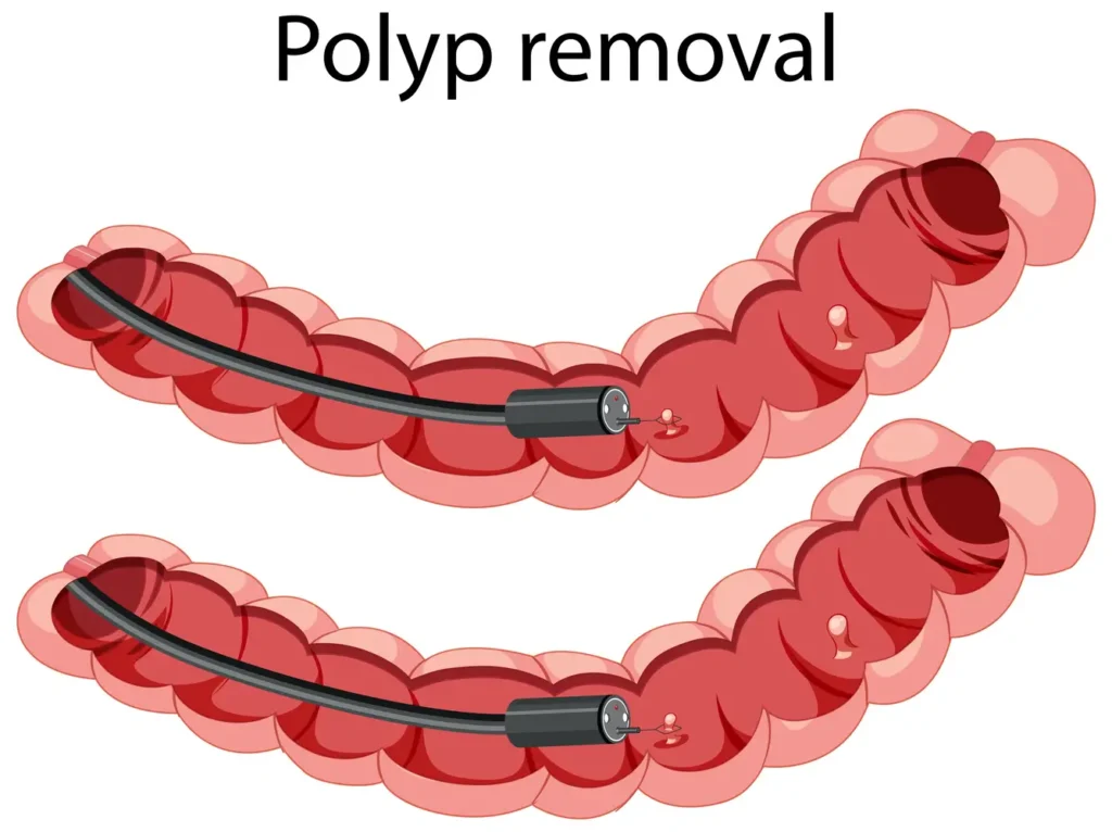 clinica_de_endocopía_avanzada | mucosectomía endoscópica Colonoscopia mostrando un pólipo de colon