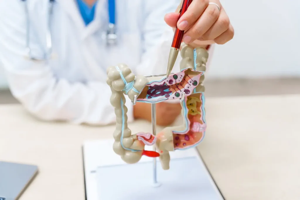 Gráfico médico explicando las causas del cáncer colorrectal