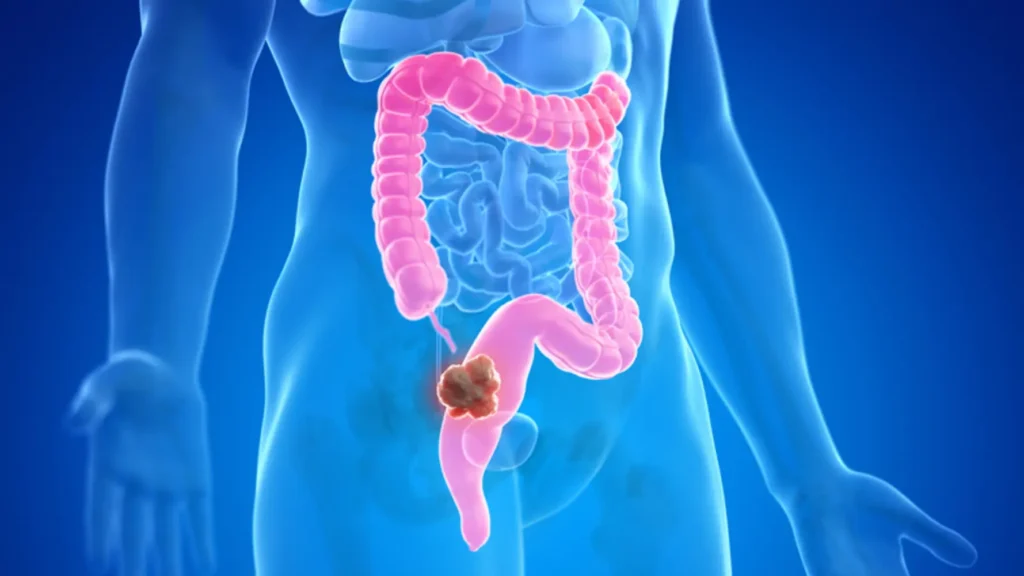Imagen de heces con sangre como signo de cáncer de colon