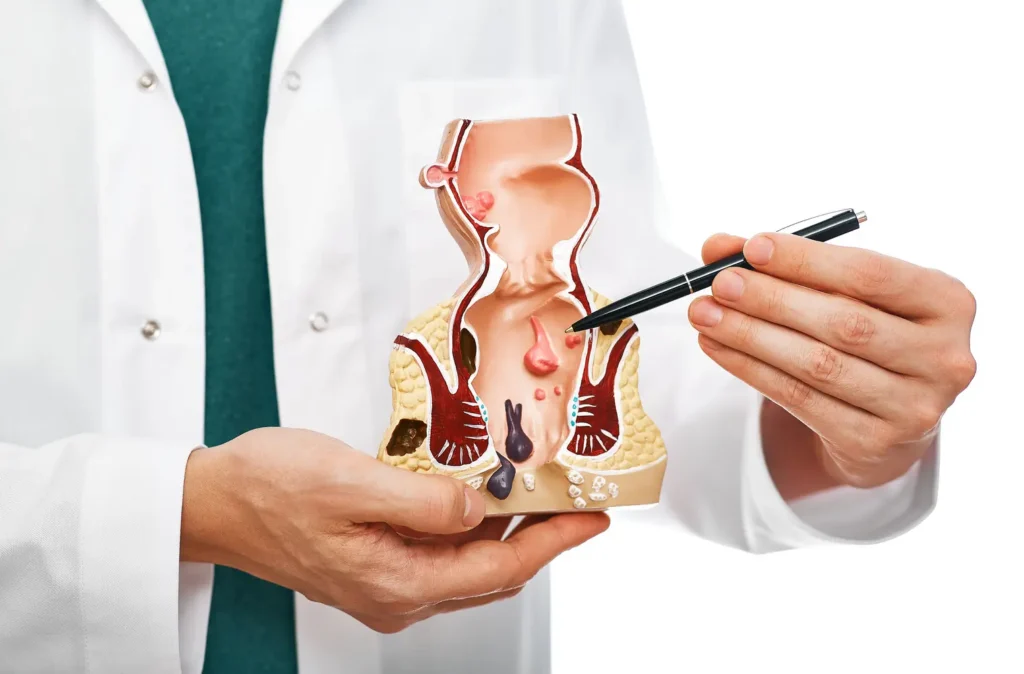 Imagen ilustrativa del recto mostrando hemorroides internas - clinica de endoscopia avanzada