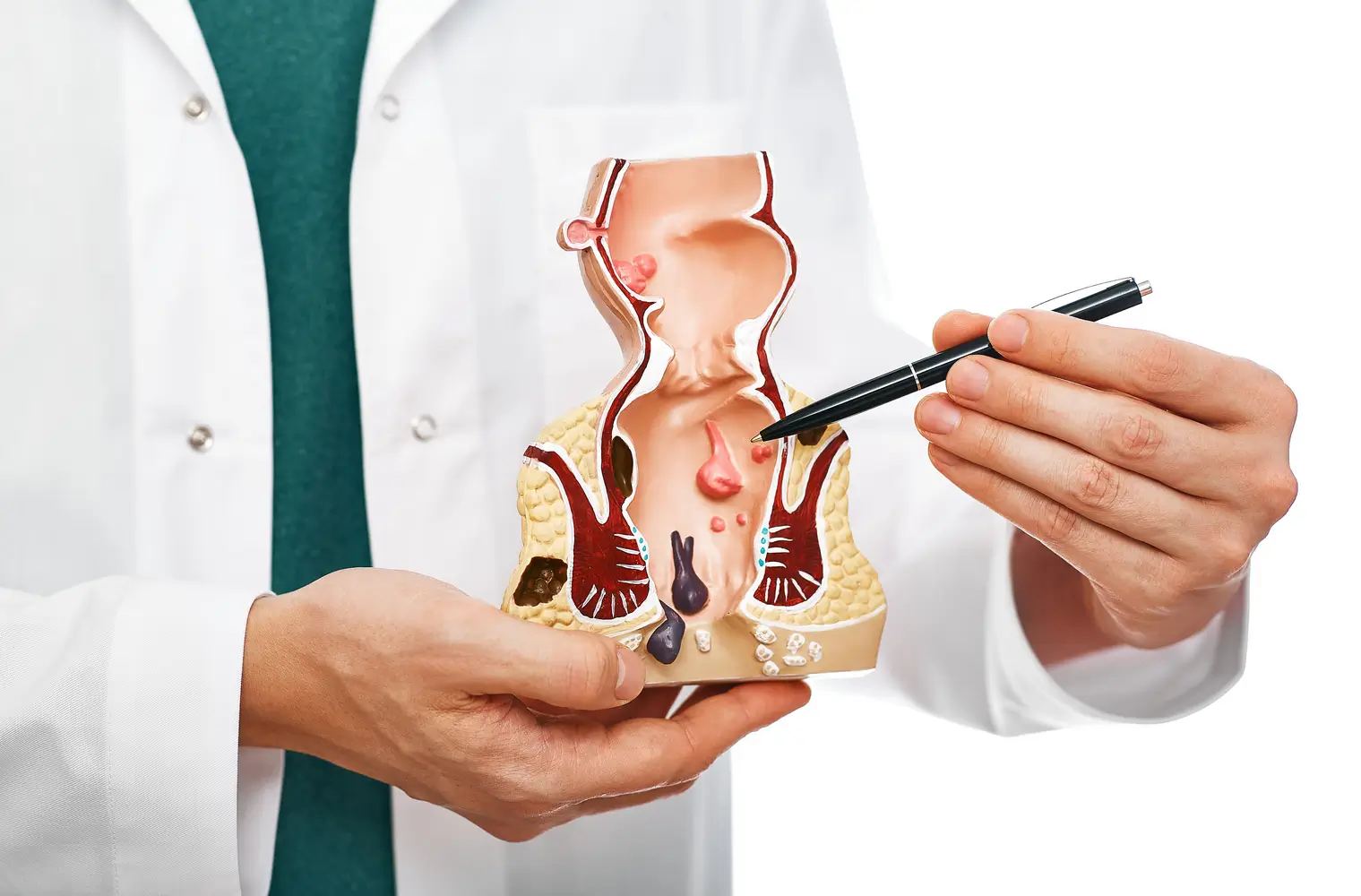Imagen ilustrativa del recto mostrando hemorroides internas - clinica de endoscopia avanzada