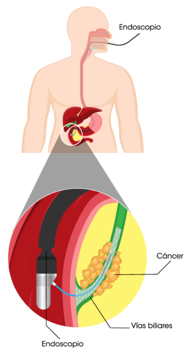 clinica_de_endocopía_avanzada | CPRE CPRE-ilustracion-procedimiento