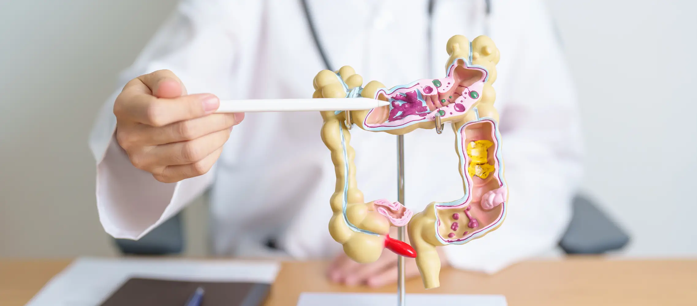 Diagrama anatómico del colon con ubicación del pólipo hiperplásico colon - clinica de endoscopia avanzada