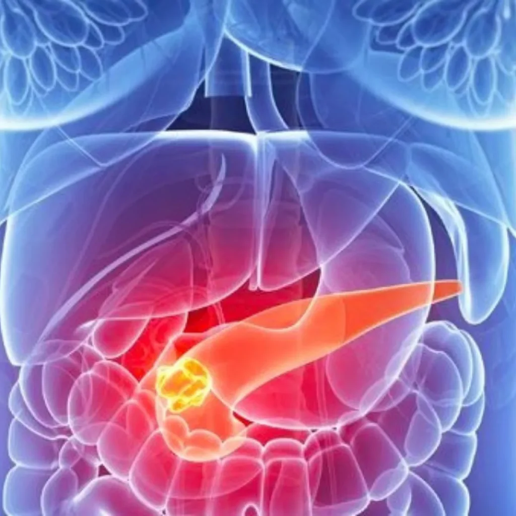 clinica_de_endocopía_avanzada | CPRE cpre-clinica de endoscopia avanzada